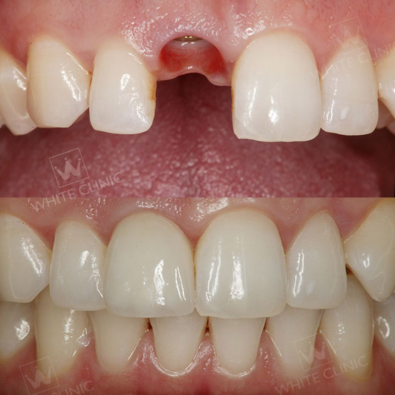 Kết quả trồng răng implant